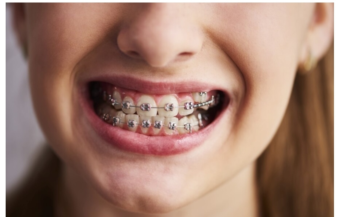 Aparat na zęby | zrzutka.pl